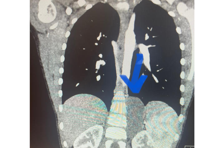 Image of MRI showing Caroline’s tumor