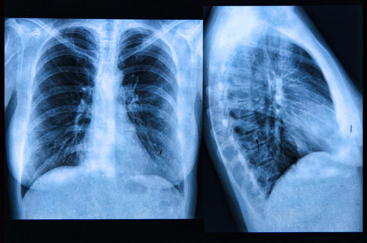 chest x-ray