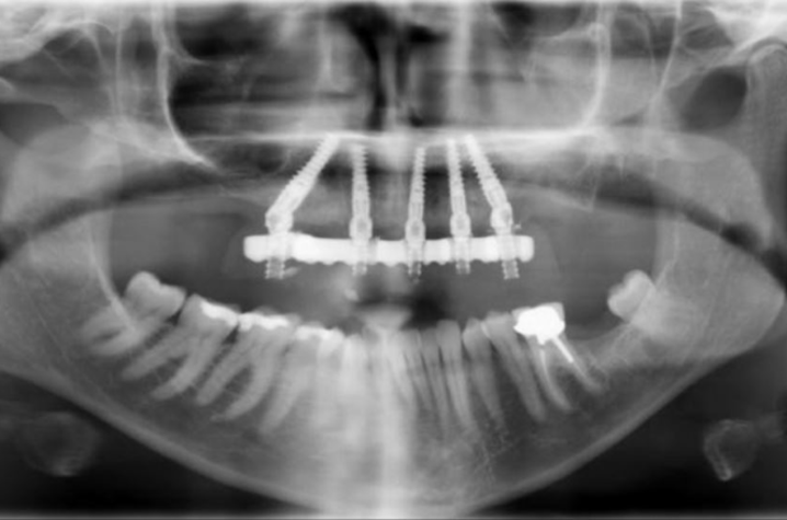 Black and white x-ray of the mouth