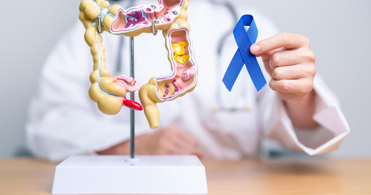 What to know about colorectal cancer rates increasing in younger adults