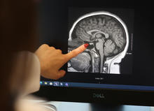 A hand points to an area on a MRI scan of the brain displayed on a computer monitor. The black-and-white medical image shows structures of the brain in profile, with measurement markings visible along the side of the scan.