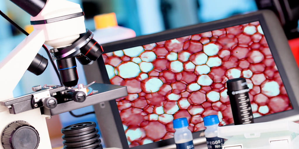 Markey Global Cancer Consortium Studies New Option for Diagnosing Lung Cancer - Vimarsana News