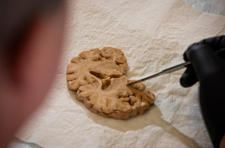 Dr. Peter T. Nelson inspects a section of brain in the neuropathology lab at the Sanders-Brown Center on Aging on April 29, 2019. Mark Cornelison | UK Photo