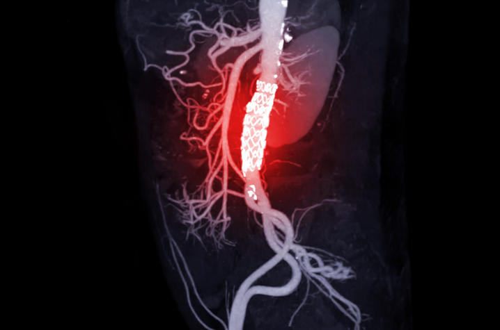 abdominal aortic aneurism