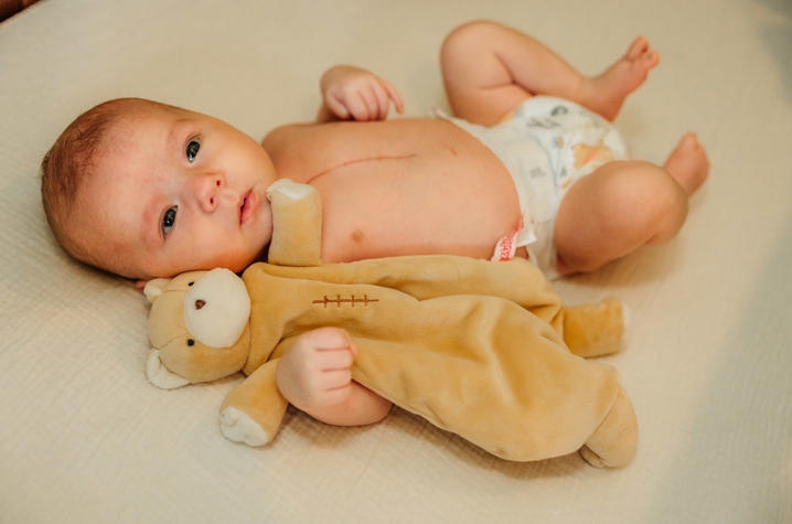 Image of baby Reid with his surgical scar, and his toy bear with the same scar