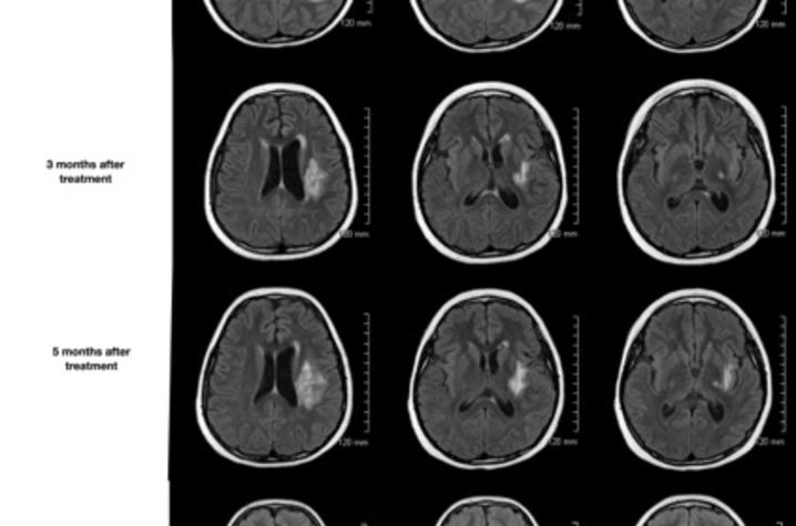 Imaging shows effect of investigational radiation necrosis treatment