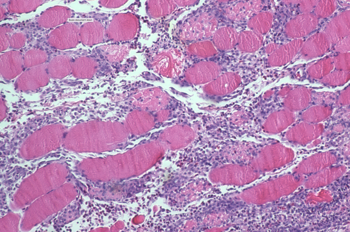 muscle atrophy histology