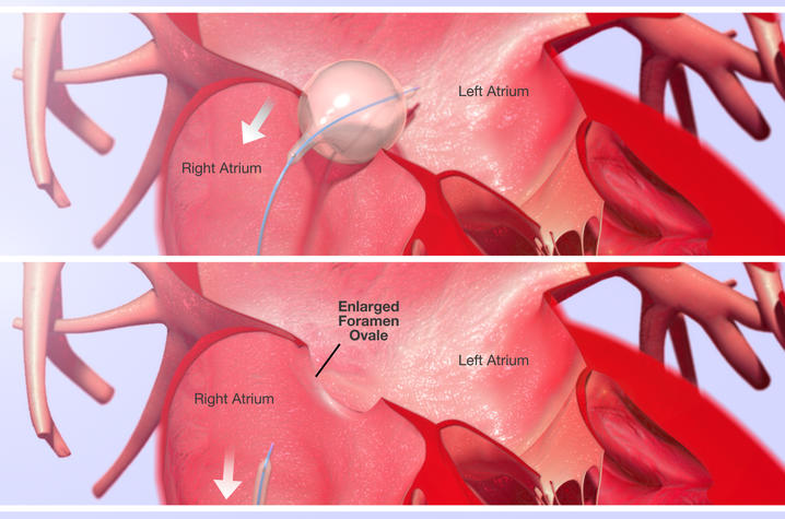 Image detailing the balloon atrial septostomy