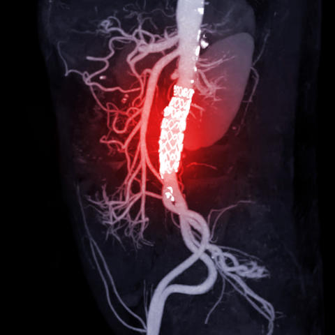abdominal aortic aneurism