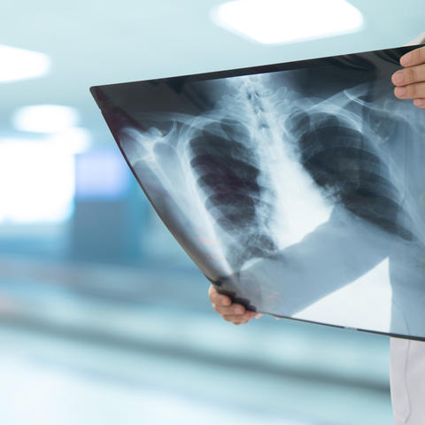 lung cancer image