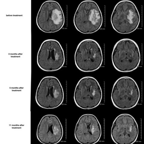 Imaging shows effect of investigational radiation necrosis treatment