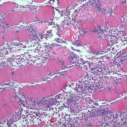 Photo of muscle cells after strenuous exercise
